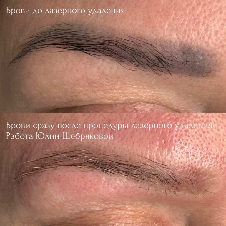 Laser Tattoo Removal: A Safe Solution for Unwanted Permanent Makeup