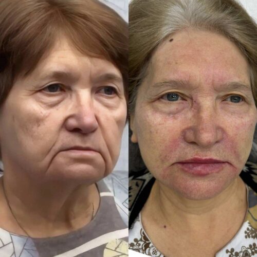 Комплексная контурная пластика лица