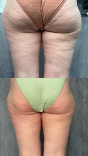 Коррекция фигуры с помощью аппаратного массажа VelaShape2 и мезотерапии