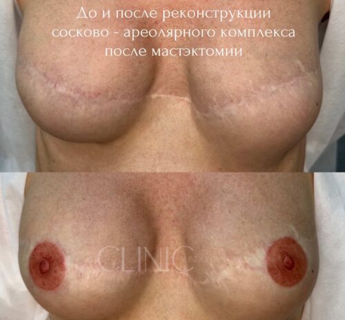 Восстановление сосковоареолярного комплекса после масктомии с помощью перманентного макияжа